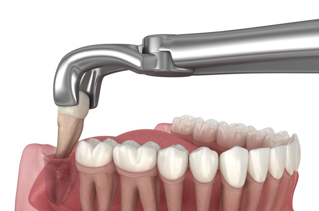 chewing tobacco after wisdom tooth extraction What Are the Best Recovery Tips for a Speedy Healing?